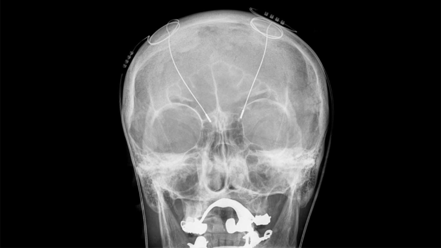 x-ray shows electrodes implanted in a human brain